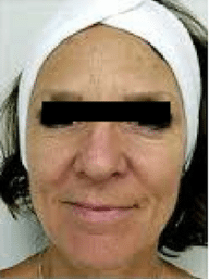 מתיחת פנים ללא ניתוח – טיפולי אנטי אייג’ינג חדשניים ללא הזרקות