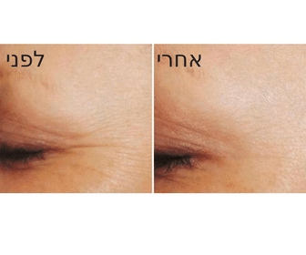 מיצוק עור הפנים - תמונות לפני ואחרי